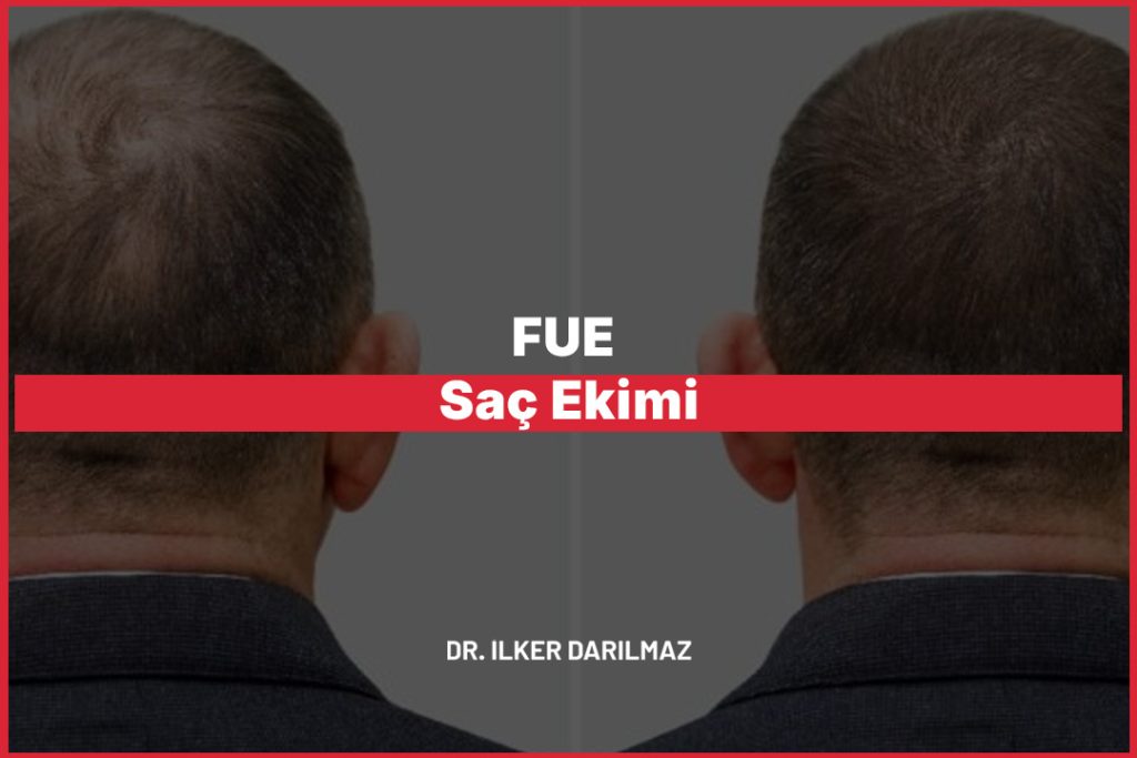 FUE Saç Ekimi