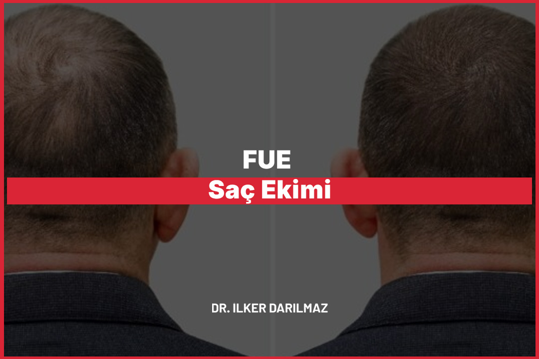 FUE Saç Ekimi