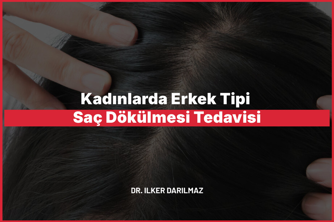 Kadınlarda Erkek Tipi Saç Dökülmesi Tedavisi