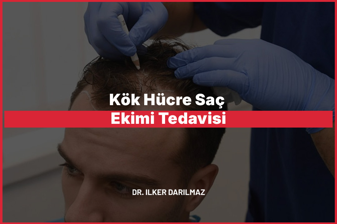 Kök Hücre Saç Ekimi Tedavisi