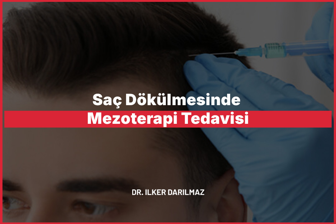 Saç Dökülmesinde Mezoterapi Tedavisi