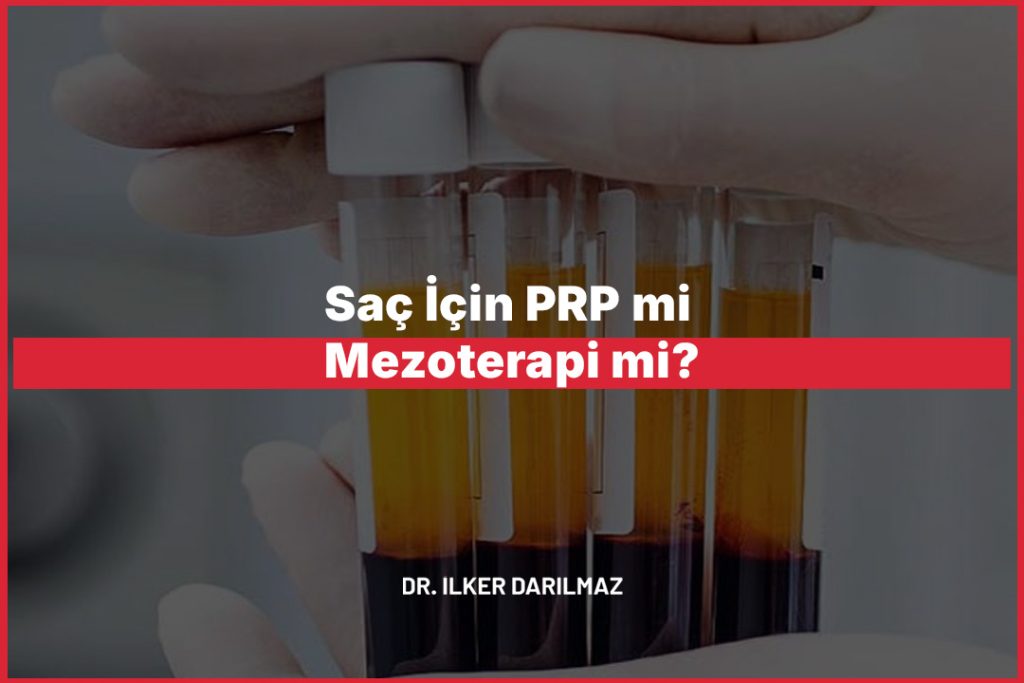 Saç İçin PRP mi Mezoterapi mi?