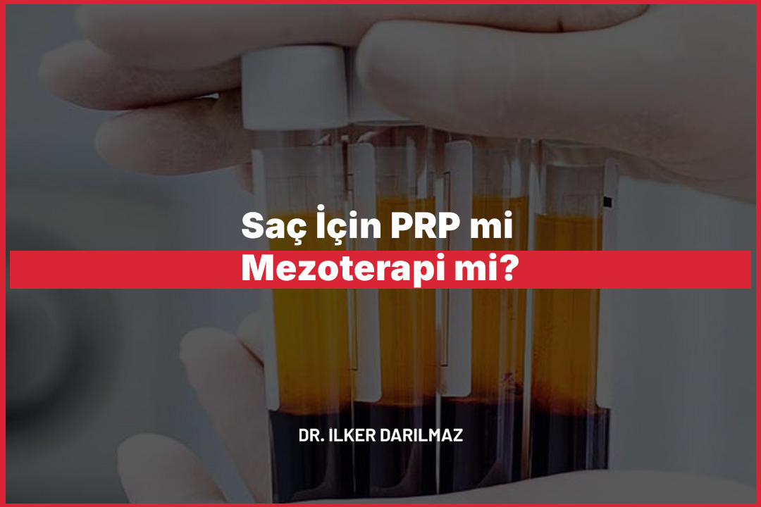 Saç İçin PRP mi Mezoterapi mi?