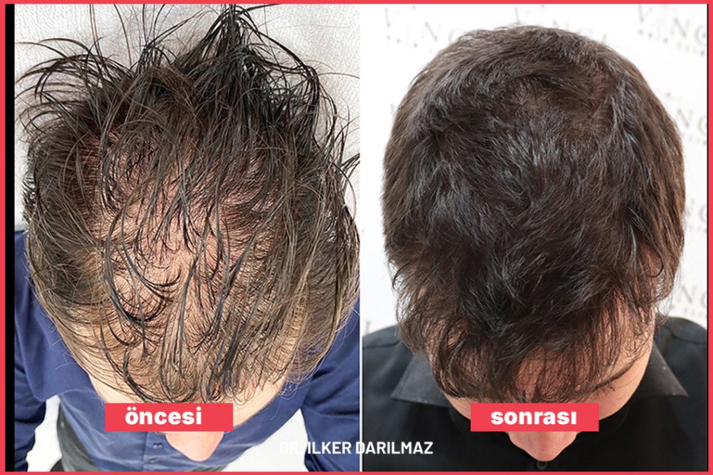 Saç Mezoterapi Öncesi Sonrası Görseller