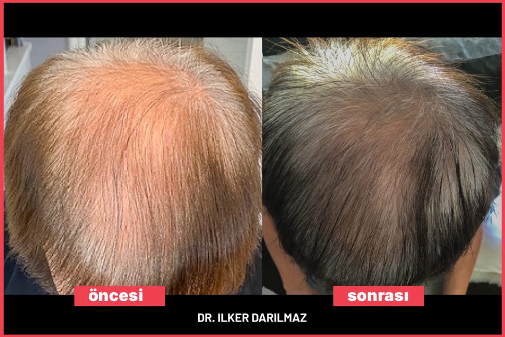 Saç Mezoterapi Öncesi Sonrası Görseller