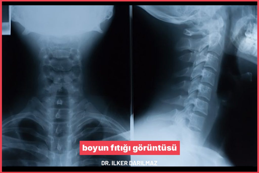 boyun fıtığı görüntüsü