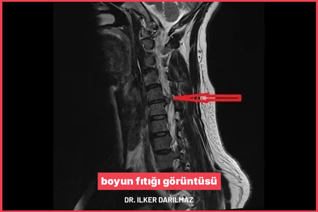 boyun fıtığı görüntüsü