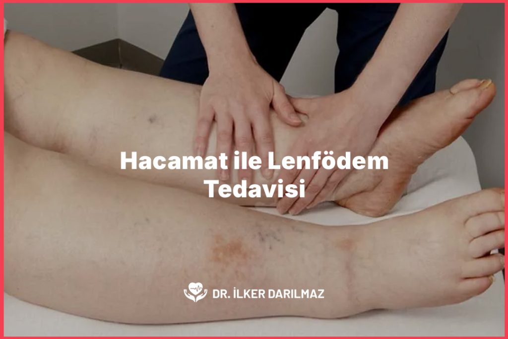 Hacamat ile Lenfödem Tedavisi