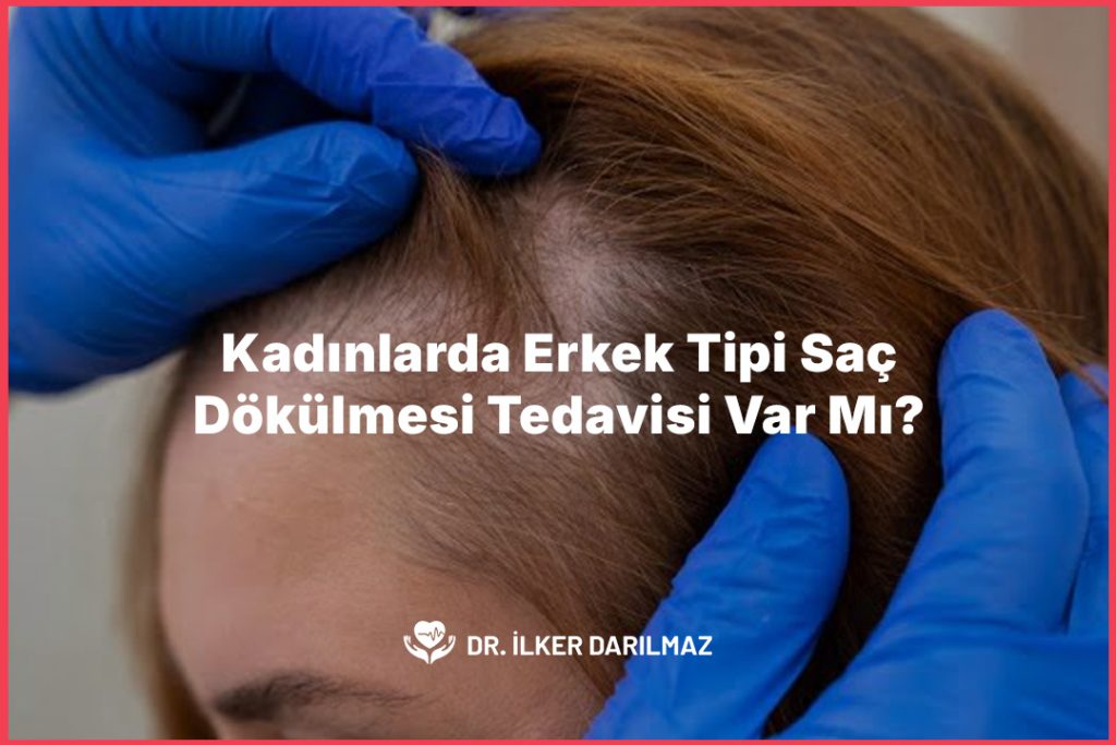 Kadınlarda Erkek Tipi Saç Dökülmesi Tedavisi Var Mı?
