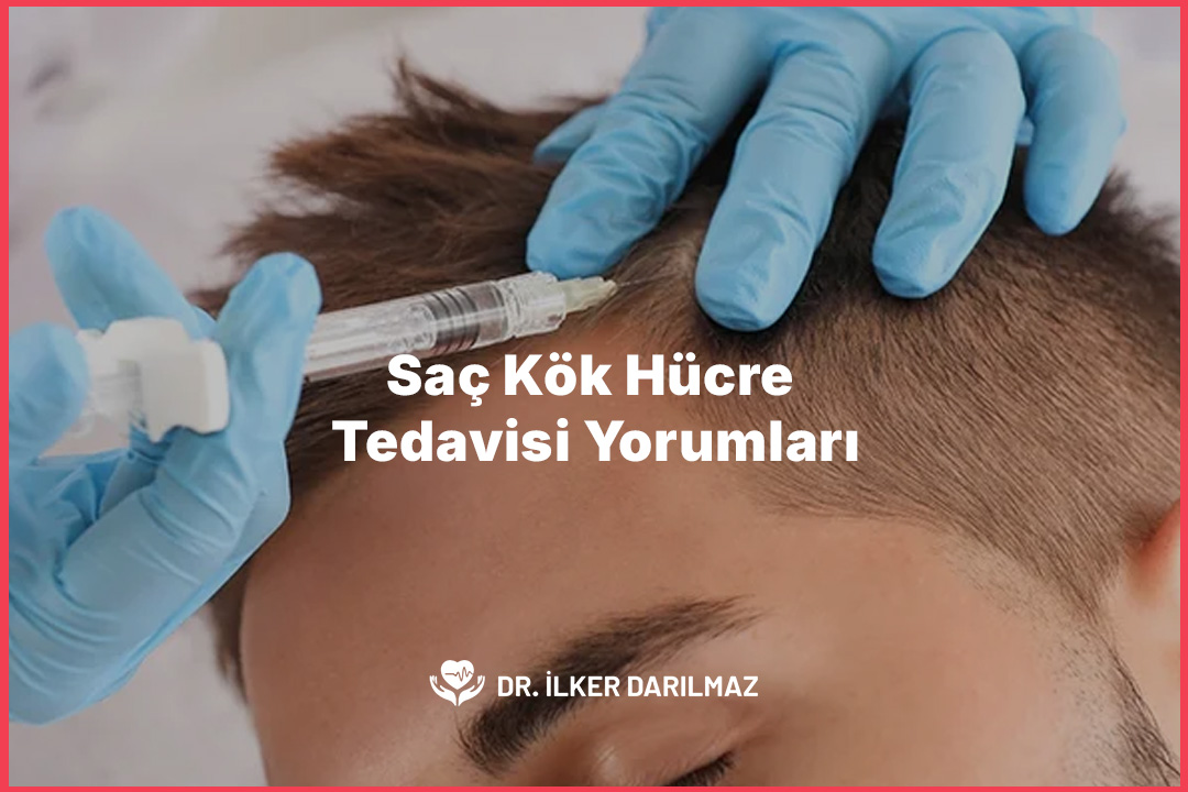 Saç Kök Hücre Tedavisi Yorumları