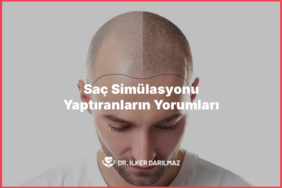 Saç Simülasyonu Yaptıranların Yorumları