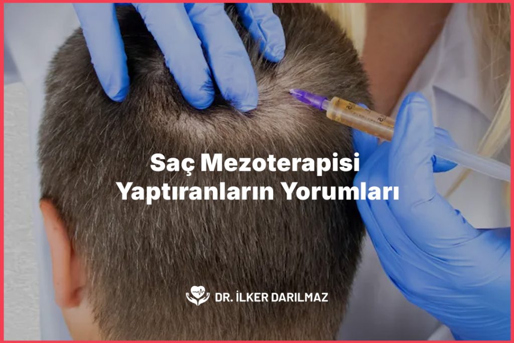 saç mezoterapisi yaptıranların yorumları