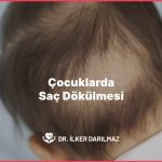 Çocuklarda Saç Dökülmesi