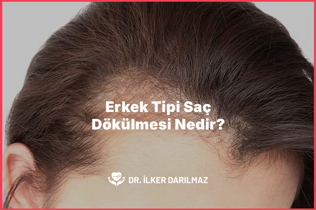 Erkek Tipi Saç Dökülmesi Nedir?