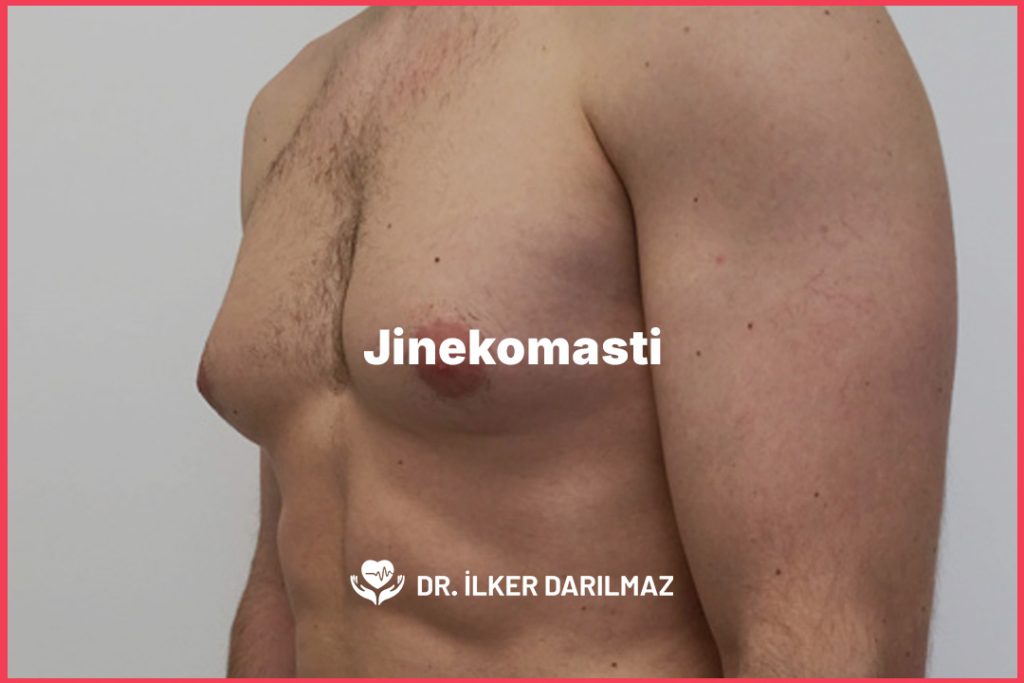 Jinekomasti