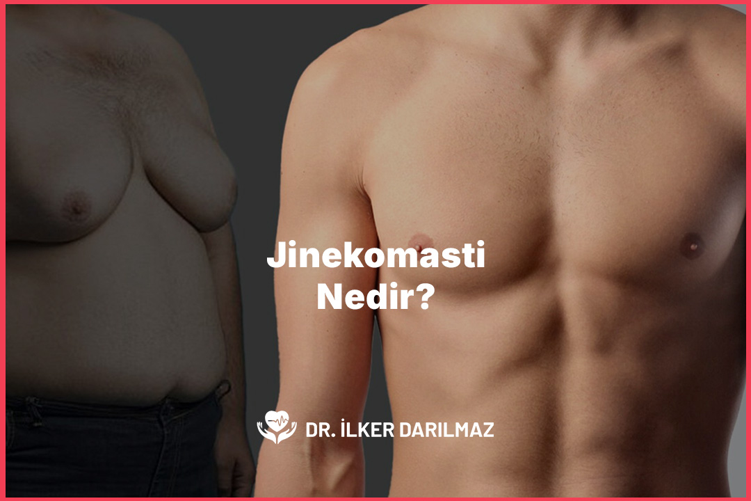 Jinekomasti Nedir?