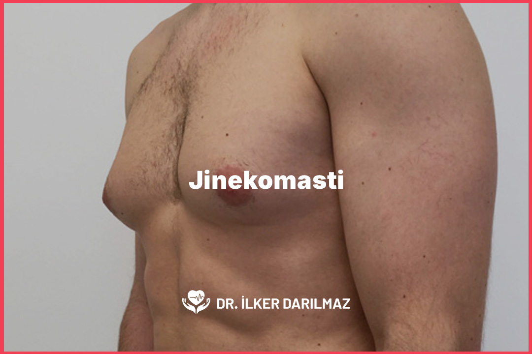 Jinekomasti