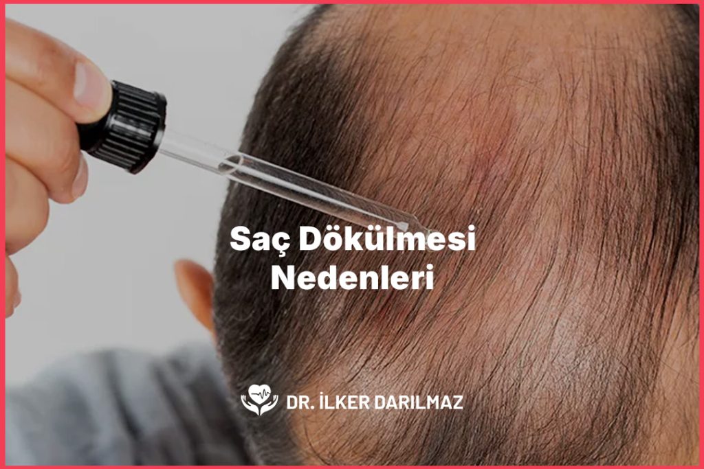 Saç Dökülmesi Nedenleri