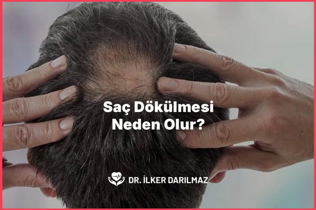 Saç Dökülmesi Neden Olur?